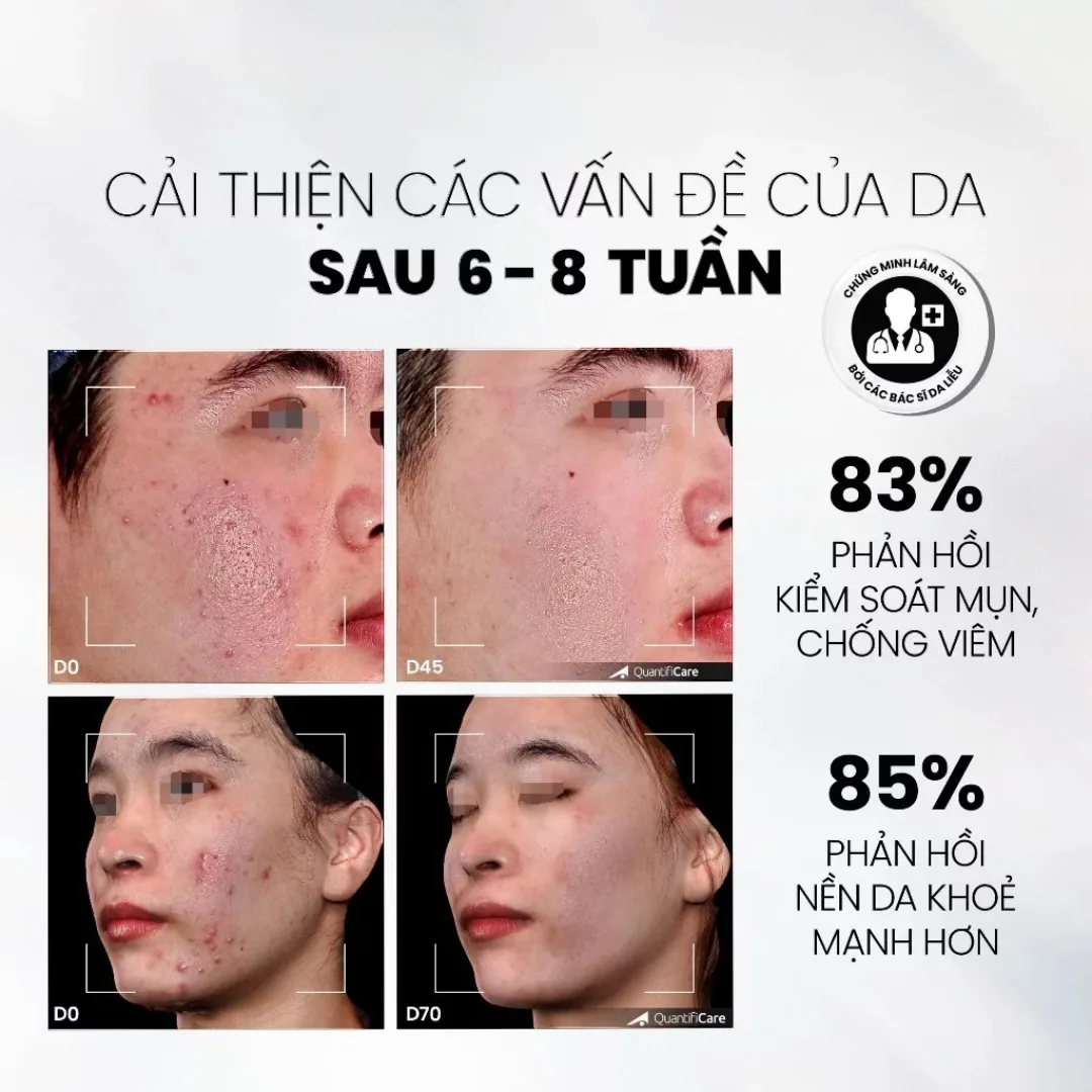 Tinh Chất Tẩy Tế Bào Chết MD CARE AntiAc Exfo Hỗ Trợ Giảm Mụn Kiềm Dầu Làm Dịu Da Cho Da Dầu Mụn 10ml/30ml 7